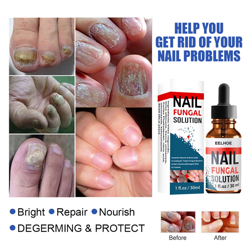 Nail Repair Essence Oil Serum Nail Treatment Perawatan Esensi Serum Jamur Kuku-30ml