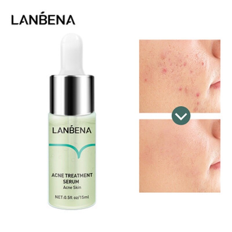 (READY &amp; ORI) LANBENA ACNE TREATMENT SERUM LB5811 5811