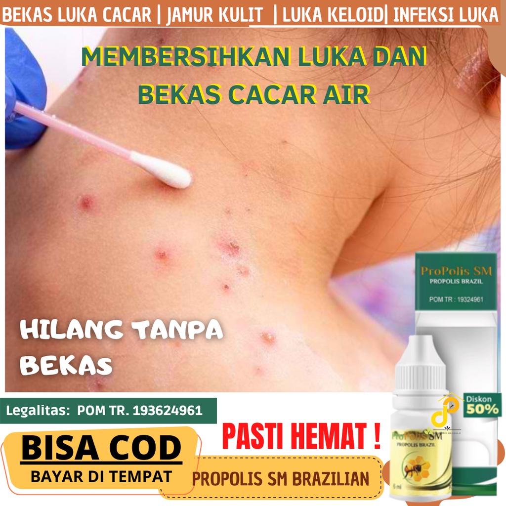 cara mengobati cacar air agar cepat kering dan hilang,  Propoolis salep cacar air biar cepat kering 
