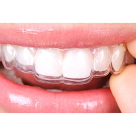 RETAINER GIGI TRANSPARAN / CLEAR RETAINER / ESSIX RETAINER
