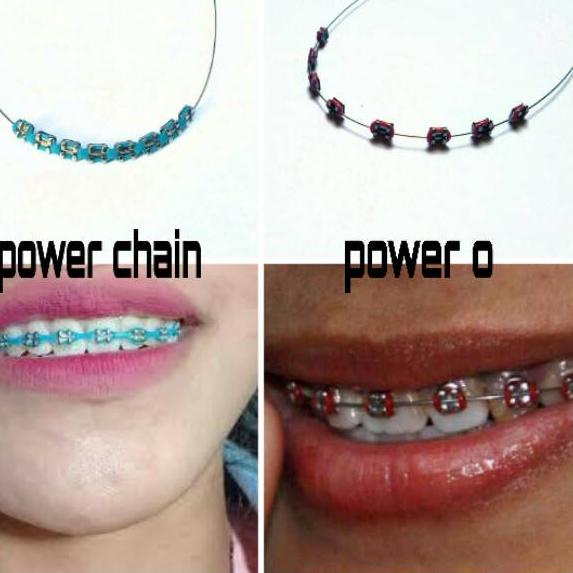 ⇼ [Bisa COD] Behel Fashion Lepas Pasang Atas/Bawah saja Bonus Karet Ganti ヒ