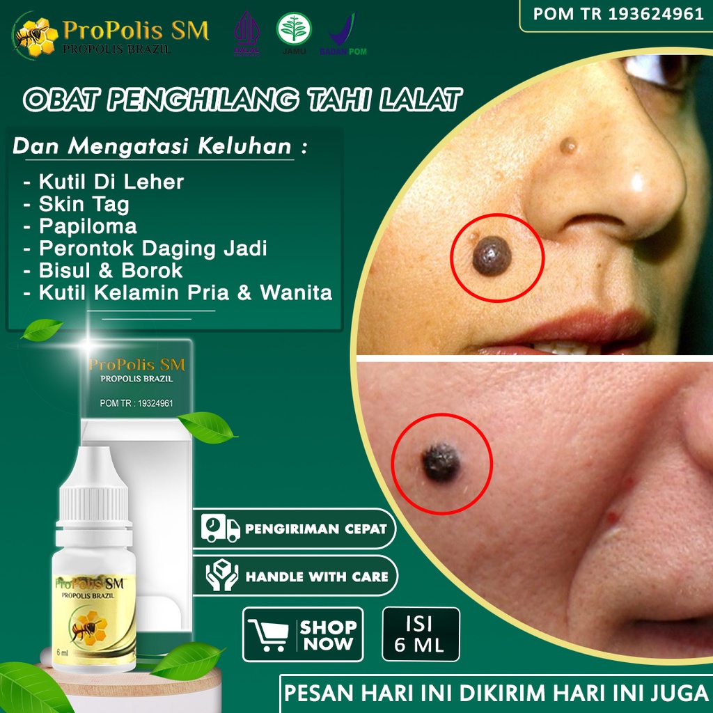 Obat Penghilang Tahi Lalat Papiloma Perontok Kutil Penghilang Skin Tag Wajah Perontok Kutil Leher Ke