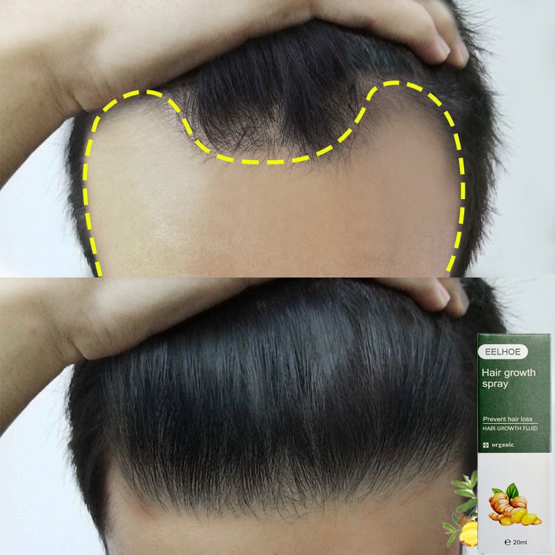 penumbuh rambut penumbuh rambut botak serum penumbuh rambut 30g serum rambut rontok Penumbuh Rambut Cepat Anti Rontok Mengatasi Botak