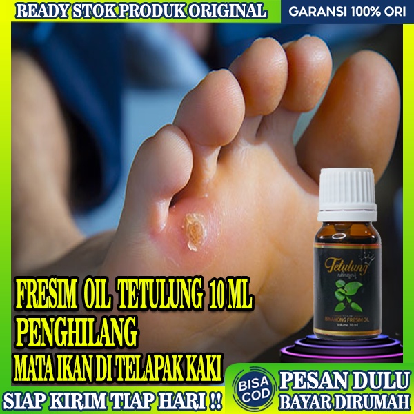 Obat Mata Ikan Telapak Kaki,Obat Kutil Ampuh,Obat Mata Ikan Pada Telapakk Kaki,Fresim Oil 10ml,Obat 
