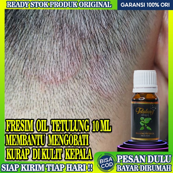 Fresim Oil 10ml Obat Kurap Paling Ampuh,Obat Psoriasis Kulit Kepala,Obat Kulit Jamur di Kulit Kepala