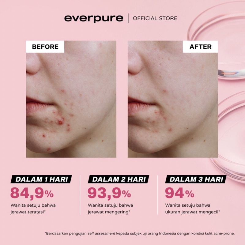 [READY STOCK&amp;FREE GIFT] EVERPURE  SUL-PURE ACNE SPOT DRYING LOTION - OBAT TOTOL ATASI JERAWAT DALAM 1 HARI DENGAN SULFUR &amp; BHA [BPOM] 3ml, 10ml, 20ml