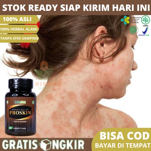 Obat Alergi, Obat Gatal Bintik Merah, Obat Alergi Kulit Gatal Bintik Merah, Obat Herbal Gatal Alergi