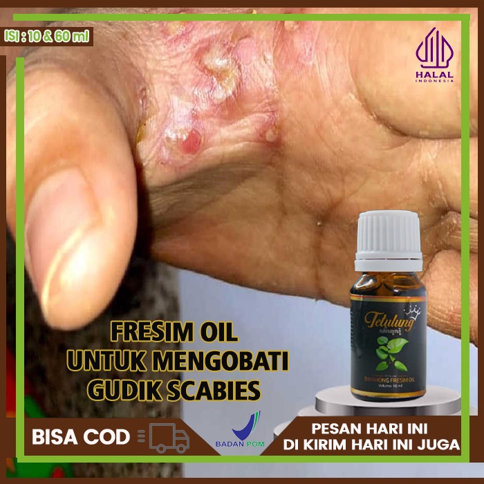 Obat Gudik Scabies Manusia, Obat Gudik Dan Gatal, Obat Scabies Manusia Borok Menahun Gudik, Obat Sca