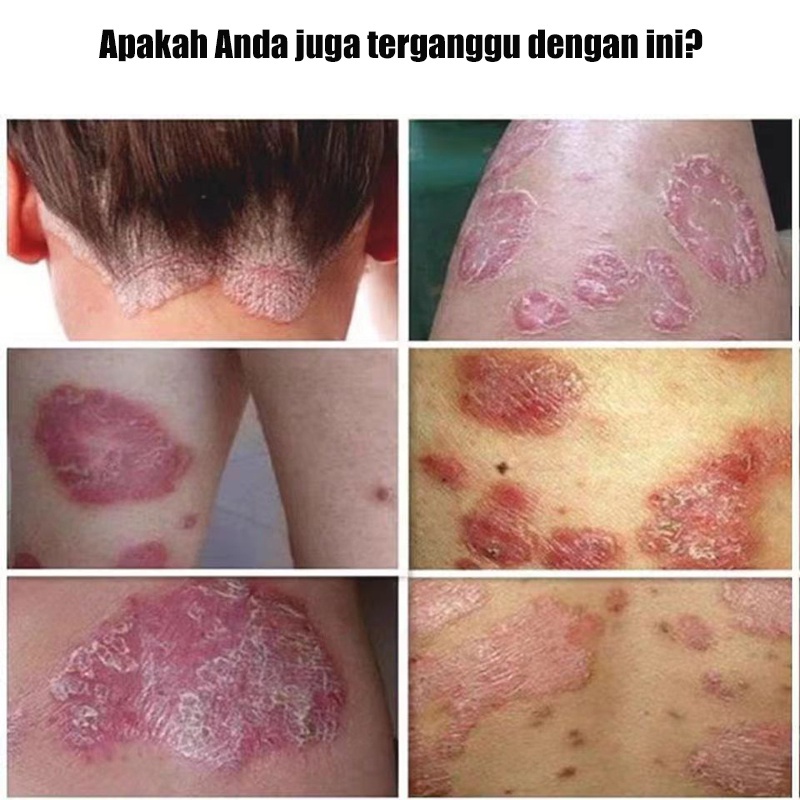 Eksim Krim Anti Jamur Krim Kurap Kulit Salep Psoriasis Krim 20g Antibakteri Antipruritik Menghilangkan Ruam Kulit Urtikaria Kurap Kudis Kudis Menghilangkan Kurap Dan Meredakan Gatal