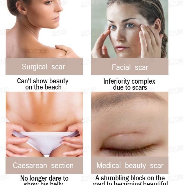 ゥ [ Original Import ] Dermatix Ultra Advanced Scar Formula Gel Cream Salep Penghilang Bekas Luka / K