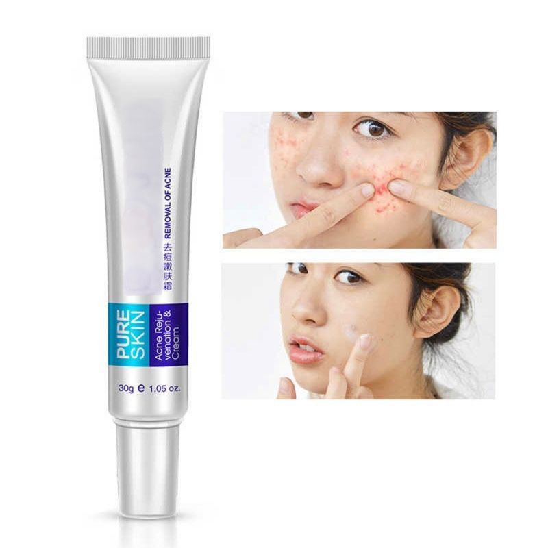 [ ORIGINAL ] Obat Penghilang Jerawat Dan Bekas Jerawat Ampuh Pure Skin Cleanser Cream Acne