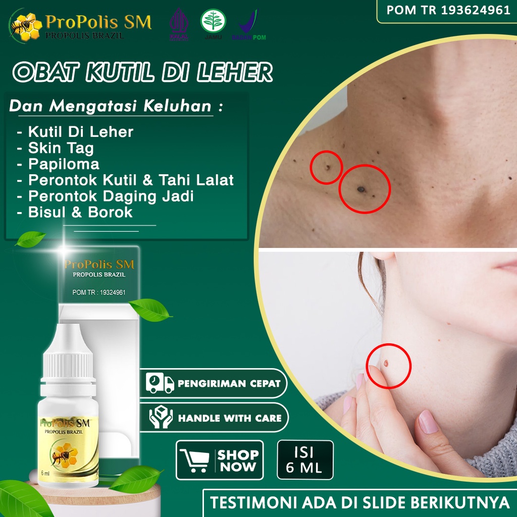 Obat Papiloma Obat Kutil Di Leher Perontok Skin Tag Dan Tahi Lalat Penghilang Benjolan Di Leher Kelo