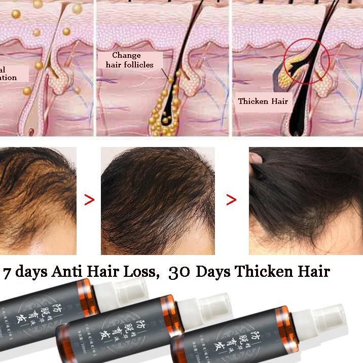 【MEGA SALE】 Hair Growth Serum Spray Original Obat Penumbuh Rambut Botak Rontok Pria Wanita Ampuh Cin