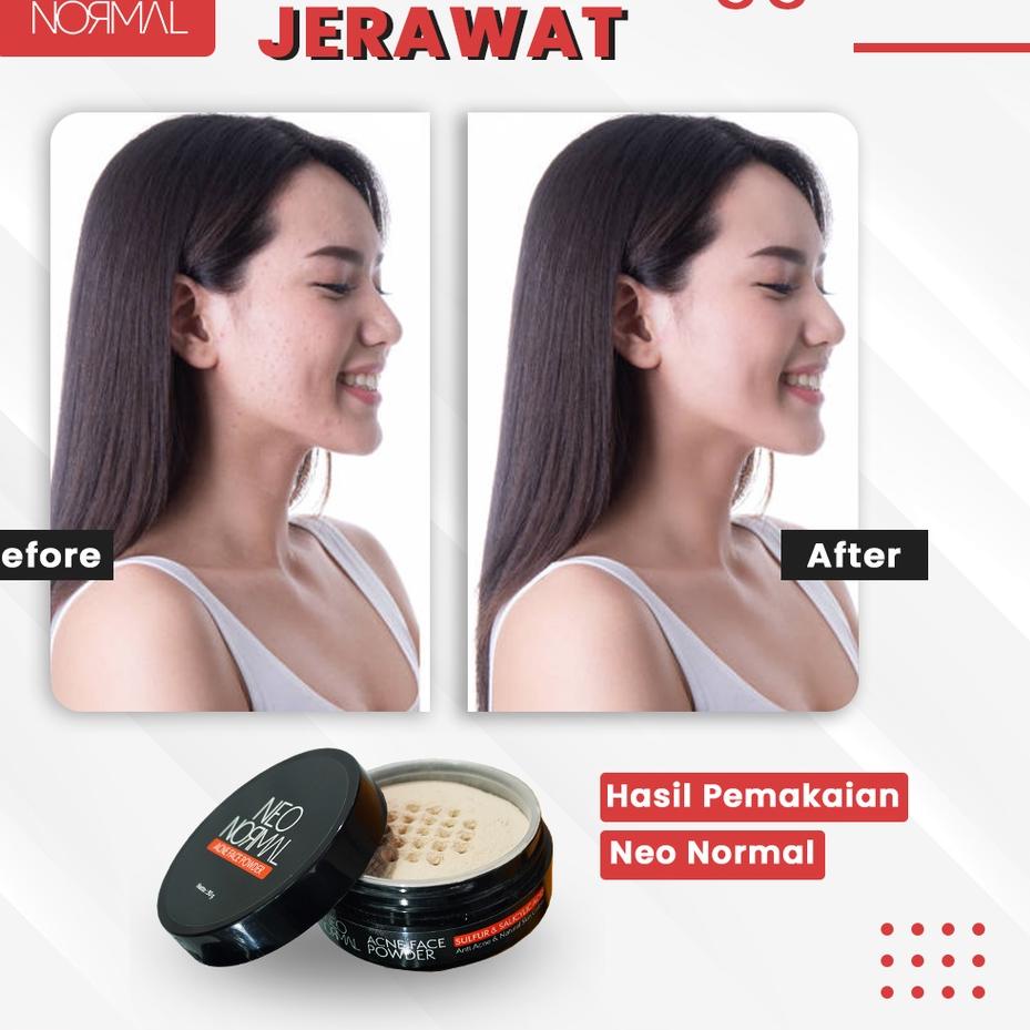 Update  100% ORIGINAL NEO NORMAL ACNE FACE POWDER NEO NORMAL ACNE FACE POWDER ORIGINAL NEO NORMAL AC