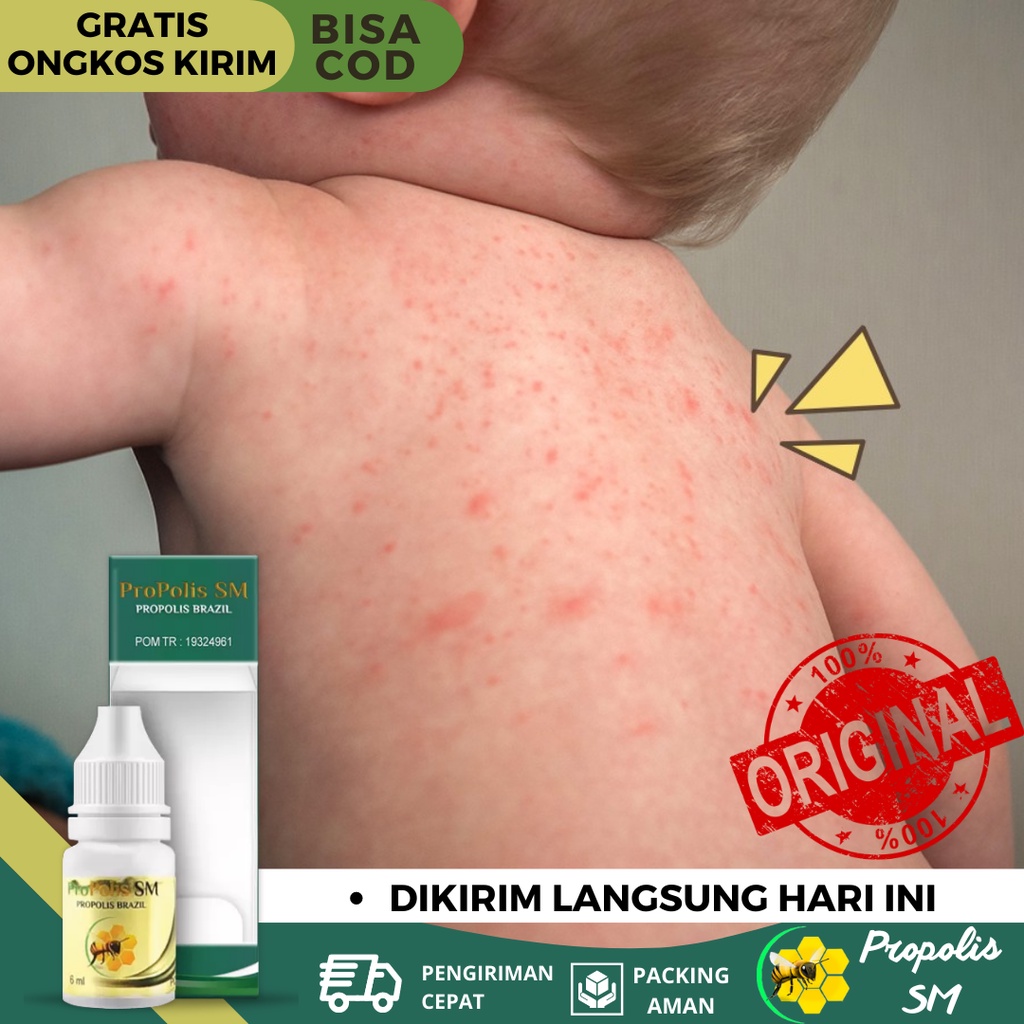 Obat Gatal Biang Keringat, Obat Biang Keringat di Wajah, Obat Biang Keringat Di Punggung, Obat Gatal