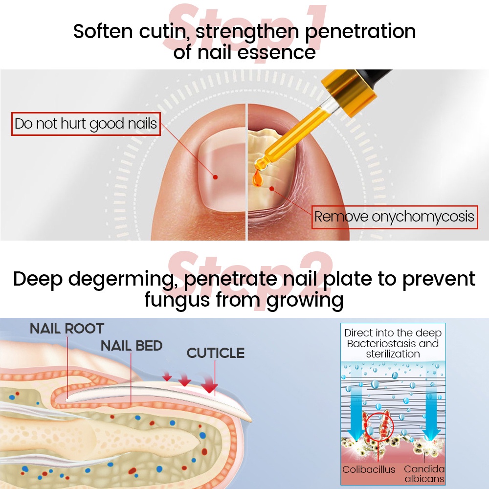 Nail Repair Essence Oil Serum Nail Treatment Perawatan Esensi Serum Jamur Kuku-30ml