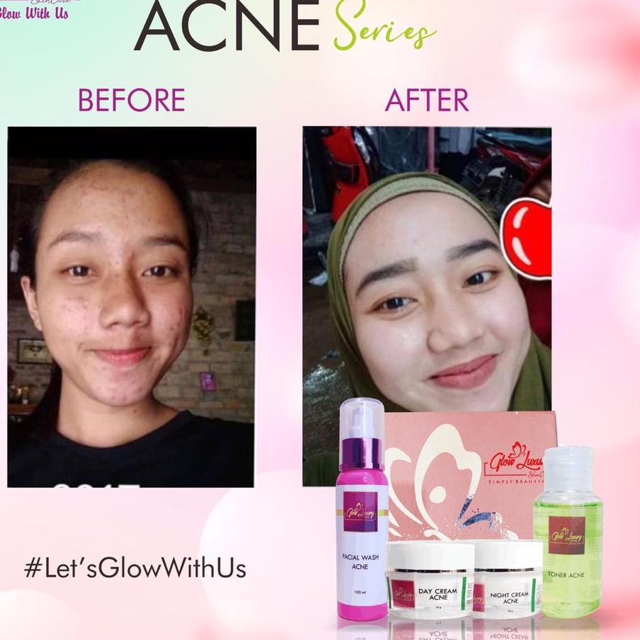 BISA COD ✔️paket glow luxury ACNE WHITENING BPOM ORIGINAL/cream jerawat/cream farmasi/cream luxury|K