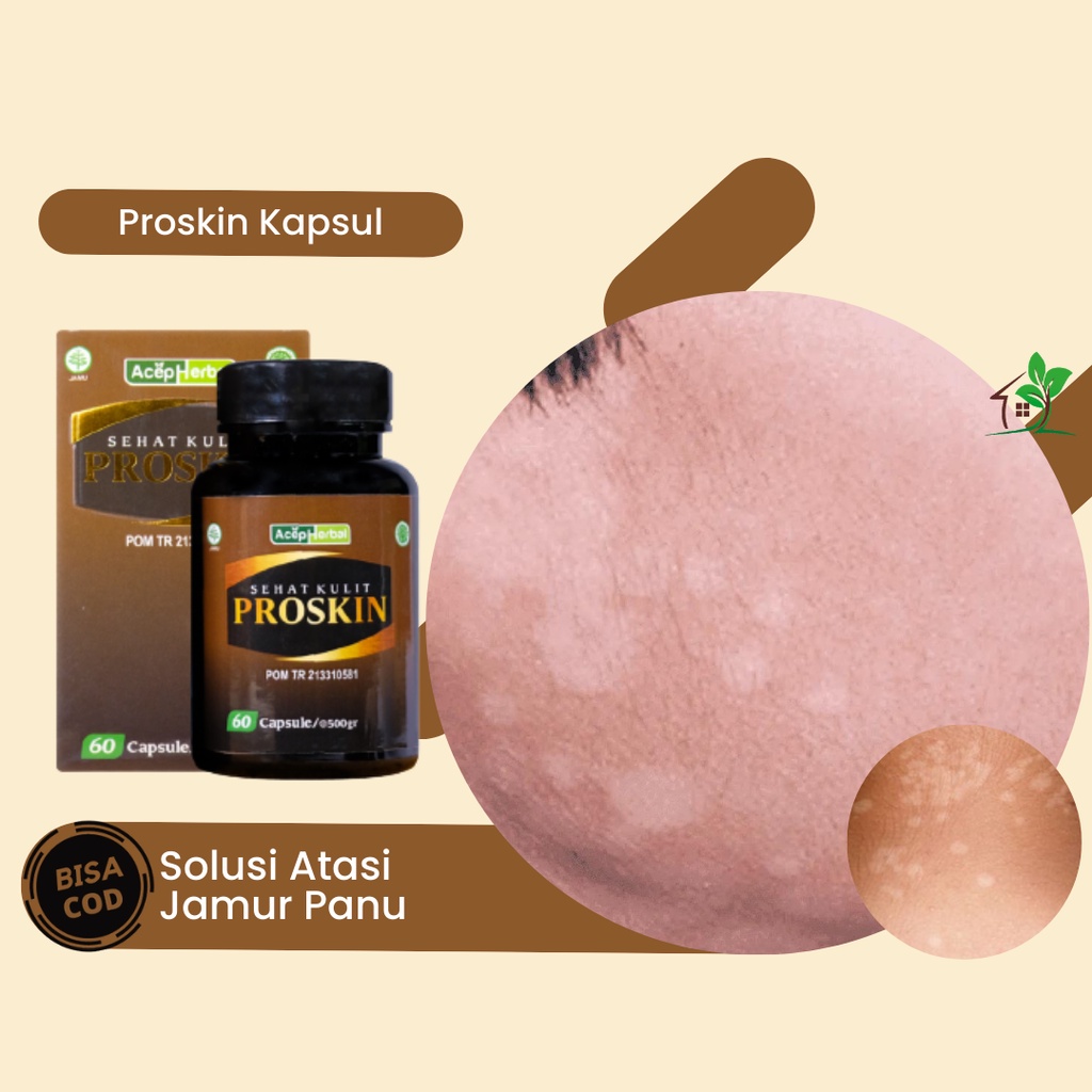 Obat Panu di Wajah, Obat Panu di Leher, Obat Panu di Punggung, Obat Panu di Menahun, Obat Bercak Put