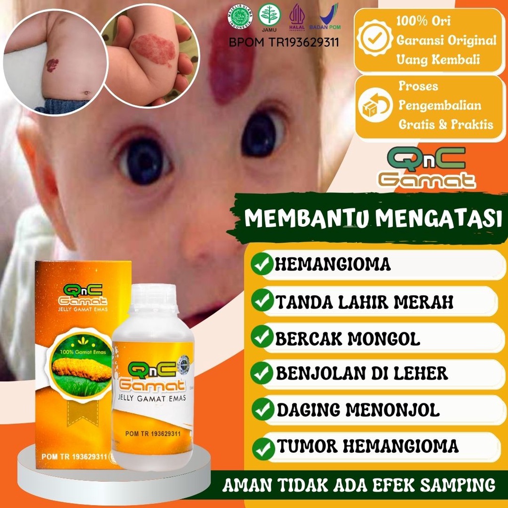 Obat Hemangioma Bayi Tumor Hemangioma Penghilang Hemangioma Tanda Lahir Merah Bercak Mongol Herbal Q