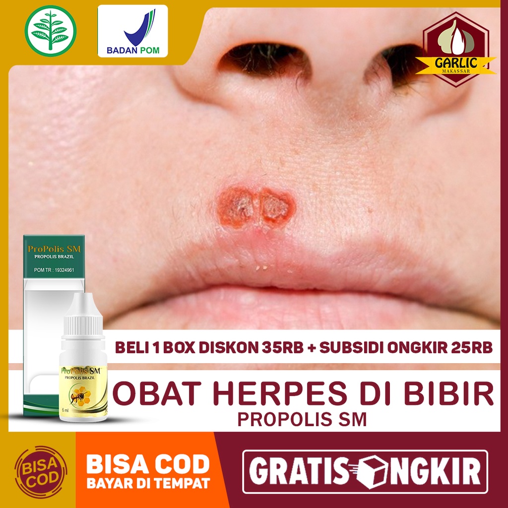 Obat Herpes Di Bibir, Luka Melepuh Sekitar Bibir, Bintik Putih Di Bibir, Gatal Area Mulut, Kelamin, 