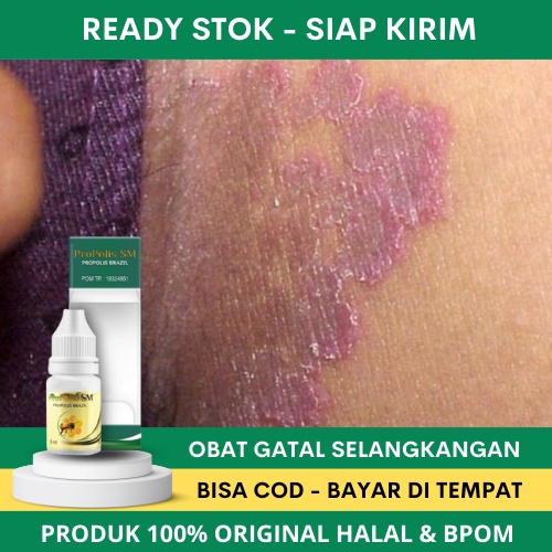 Jual Obat Selangkangan Hitam Dan Gatal, Obat Gatal Selangkangan, Obat