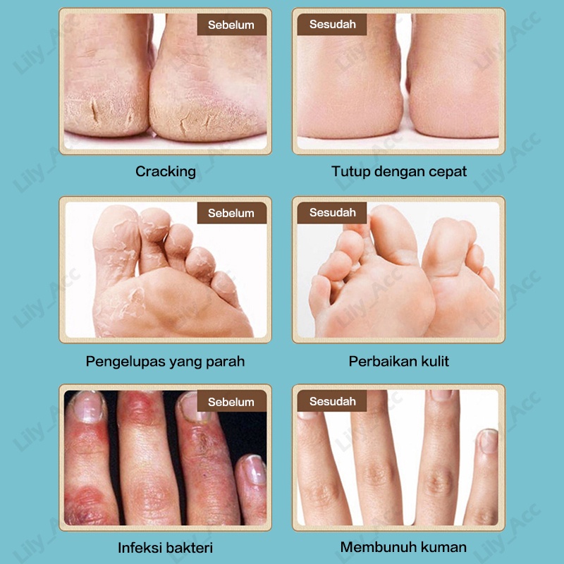 salep tangan dan kaki pecah / mengobati tumit kaki pecah , telapak tangan pecah , mengelupas, celah/ krim tangan , krim perbaikan / menghidrasi melembabkan, memperbaiki tumit kaki , telapak tangan