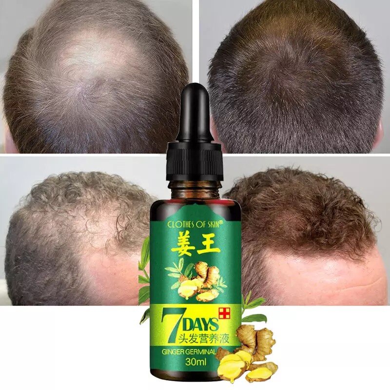 Serum Penumbuh Rambut / Anti Rontok Botak Ginger Germinal Oil-Ampuh Menumbuhkan Rambut &amp; Mencegah Kerontokkan-30ml