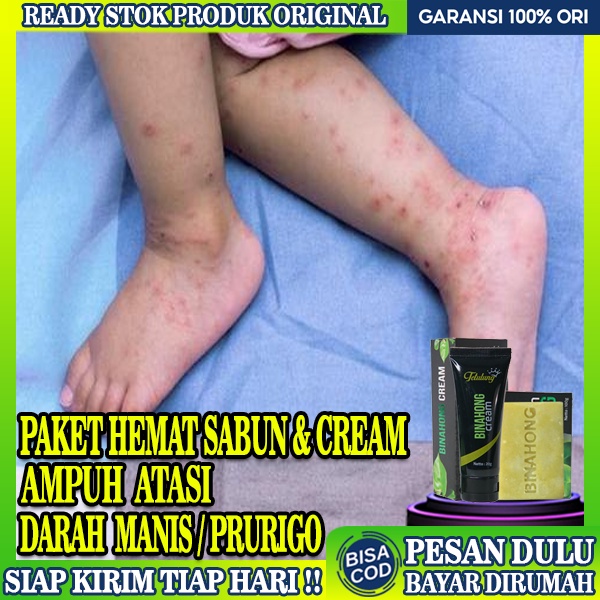 Jual Salep Binahong G Dan Sabun Obat Darah Manis Prurigo Obat Gatal Kulit Untuk Bekas Luka