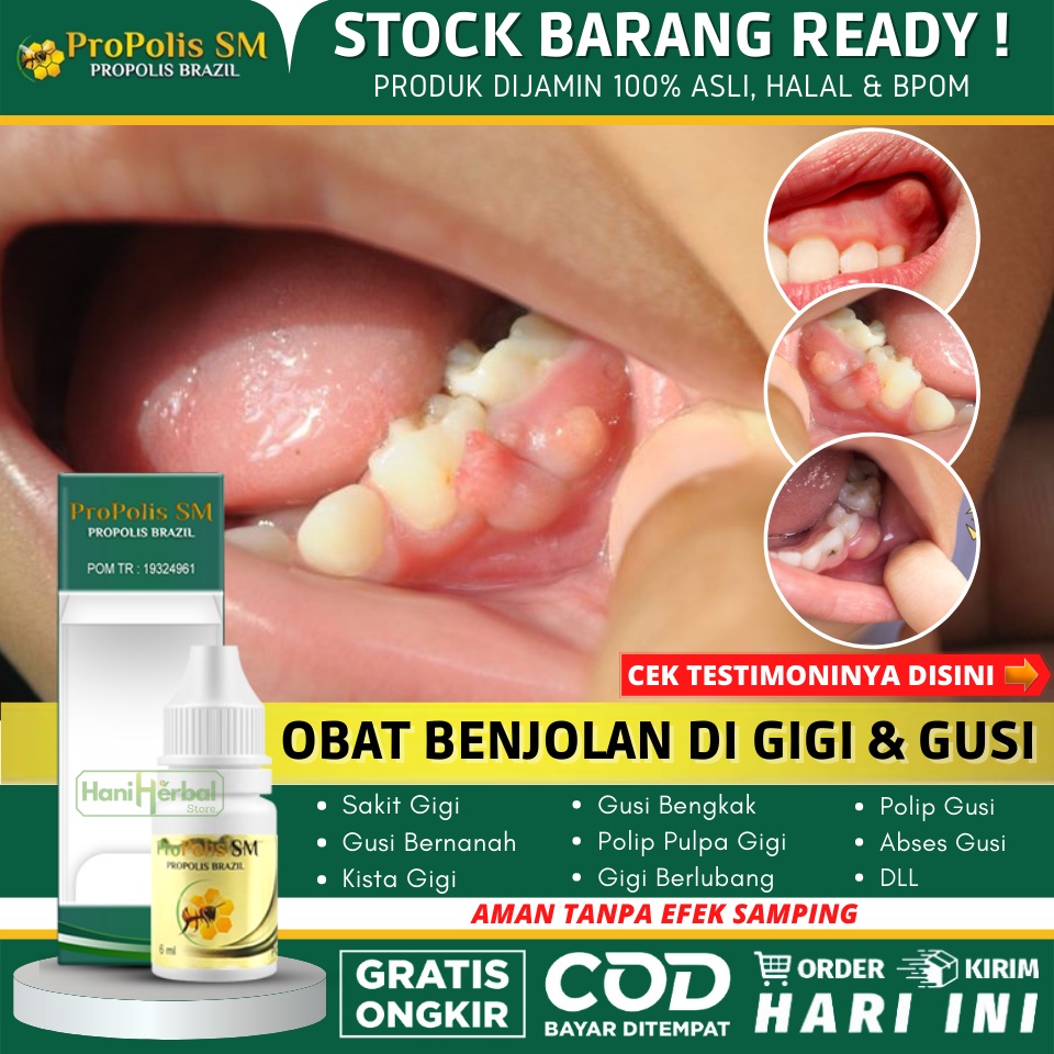 OBAT KISTA GIGI - OBAT BENJOLAN DI GUSI - PENGHILANG BENJOLAN DI GIGI BERLUBANG - TUMOR GIGI - ULKUS
