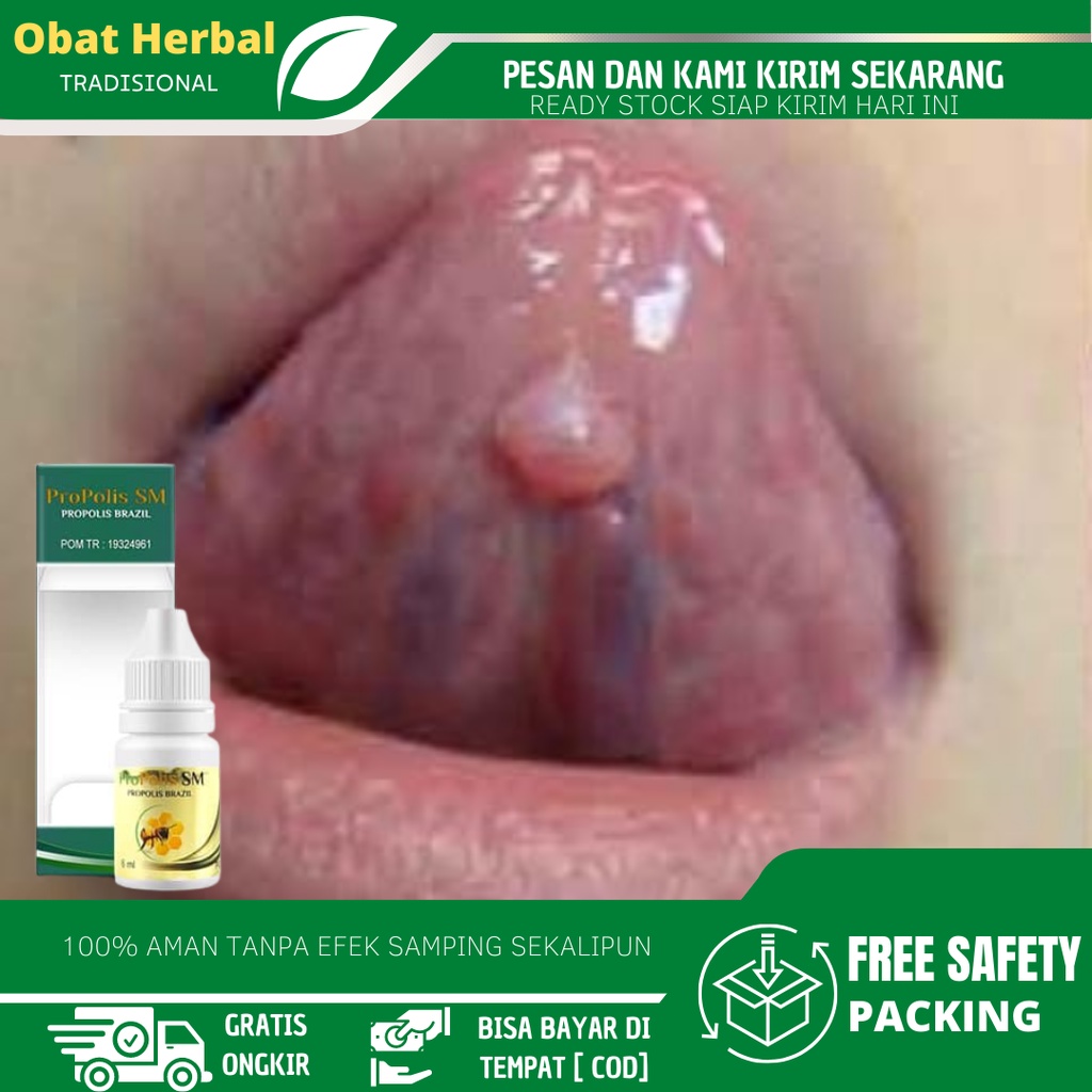 Obat Benjolan Di Bawah Lidah, Obat Benjolan Atas Langit Mulut, Obat Pengempis Benjolan Lidah, Obat K