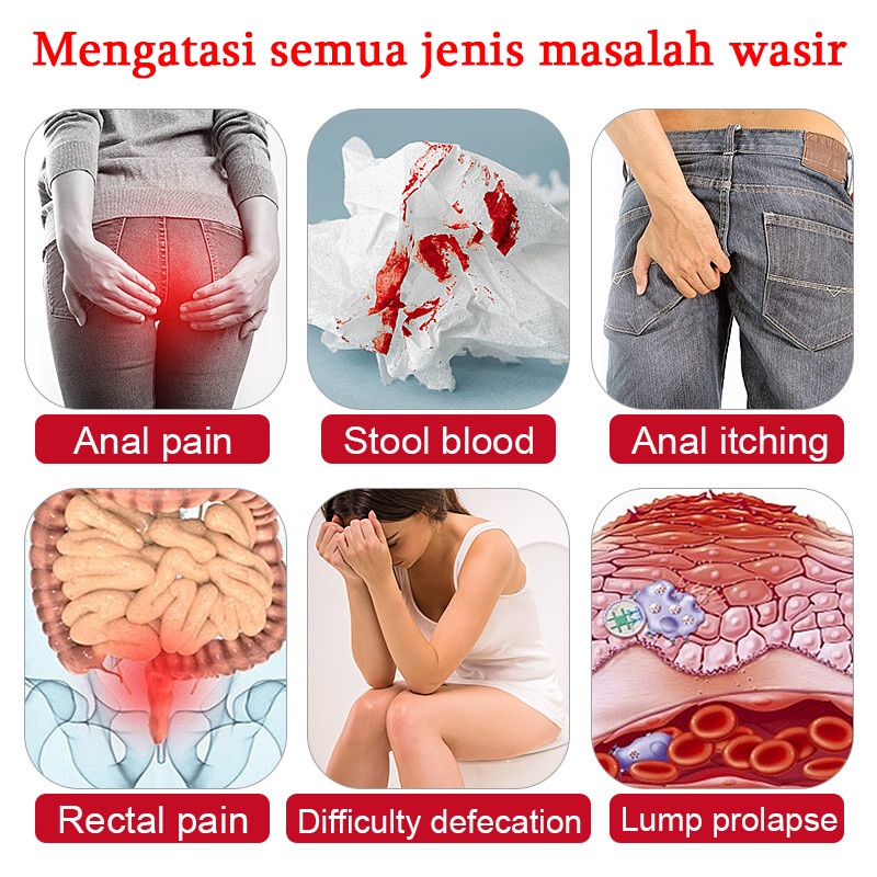 Obat wasir Salep wasir Krim wasir 20G Obat herbal alami, aman dan tidak berbahaya, cepat dan efektif menghilangkan wasir, menghilangkan benjolan, wasir dalam, wasir luar, wasir campuran, gatal pada anus, luka pada lubang anus