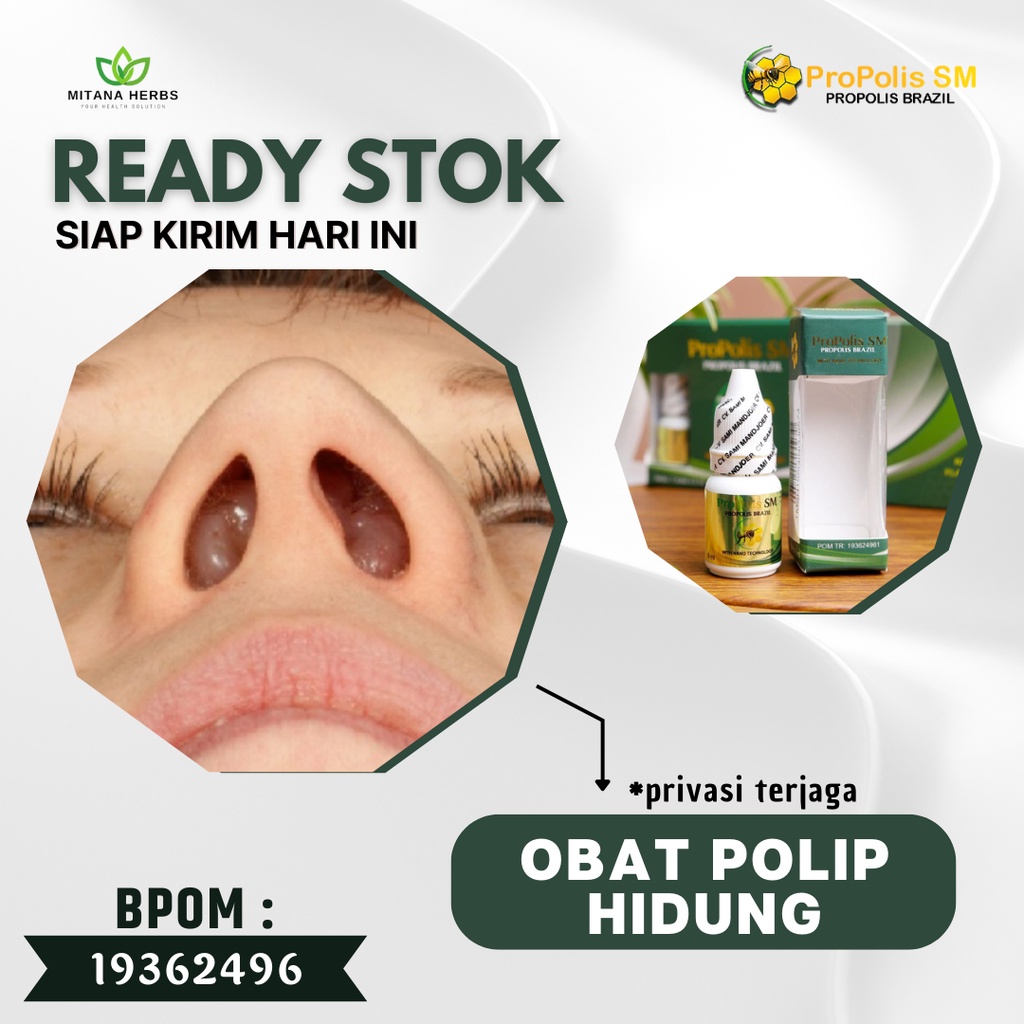 Mitana Herbal - Obat Benjolan Di Hidung - Obat Polip Hidung - Obat Polip Hidung Anak