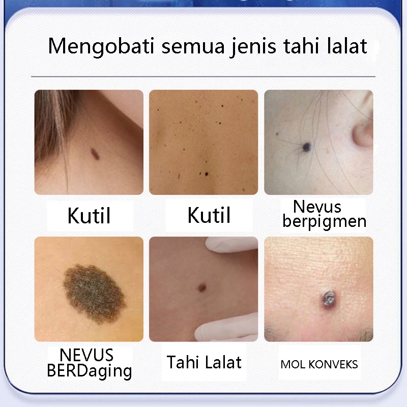 20G Obat Perontok Kutil, Obat Papiloma Penghilang Kutil,Obat Mata ikan,Kutil,Kapalan Wanita - Salep Kutil Kelamin - Obat Papiloma Di Leher, Repair And Clean Skin Tag Remover