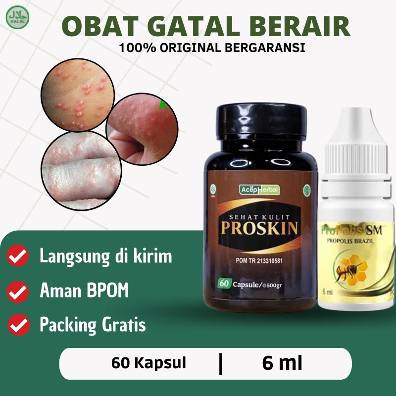 Jual Proskin Obat Kutu air, Obat Gatal berair, Obat Gatal kutu air