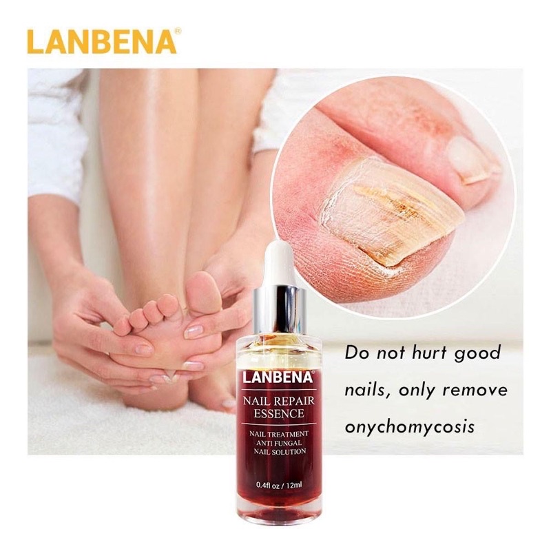 LANBENA Serum Obat Penghilang Jamur Kuku Nail Repair Perawatan Esensi Essence Oil Serum Nails Treatment