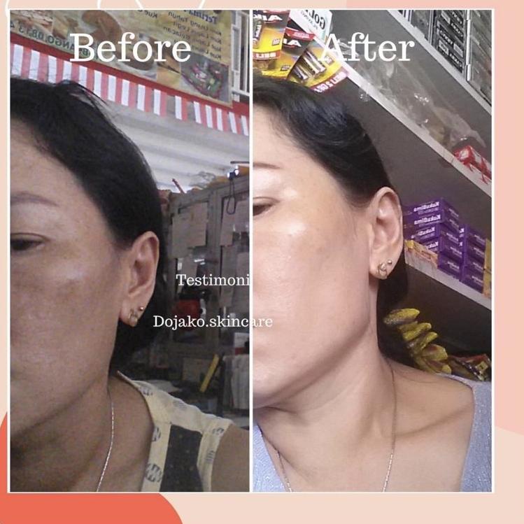 Pesan disini--BEST SELLER PAKET FLEK HITAM + GLOWING DOJAKO SKINCARE IMPORT