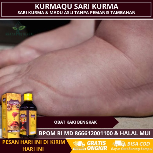 Obat Untuk Kaki Bengkak, Obat Kaki Bengkak Dan Nyeri, Mengempeskan Kaki Bengkak, Obat Kaki Bengkak A