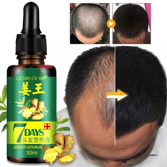 Serum Penumbuh Rambut / Anti Rontok Botak Ginger Germinal Oil-Ampuh Menumbuhkan Rambut &amp; Mencegah Kerontokkan-30ml