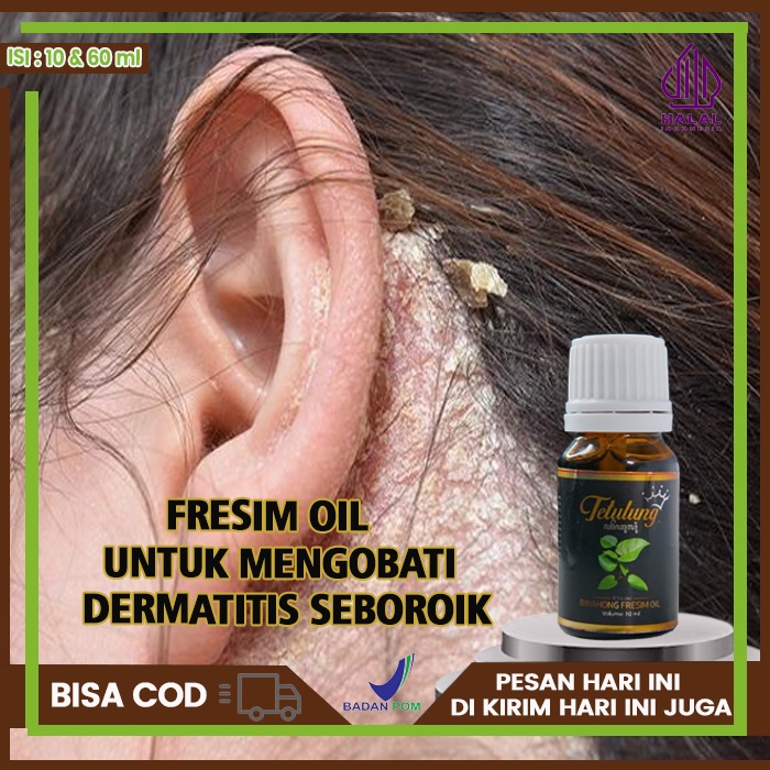 Obat Dermatitis Seboroik, Obat Oles Penyakit Dermatitis Seboroik, Obat Untuk Dermatitis Ampuh, Obat 