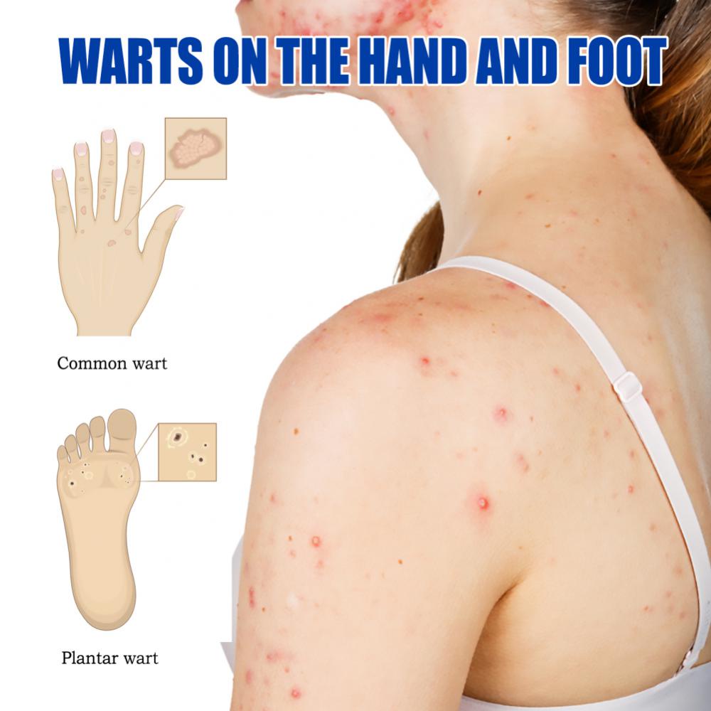 【20 gr】Skin Tag Remover Cream/Salep Obat Penghilang Tahi Lalat dan Kutil/Krim Pengilang Kutil/Wart Removal Cream