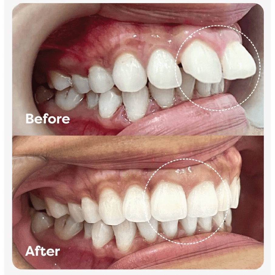 PROMO Alat perapih gigi tonggos original asli Behel perapih gigi asli Alat perapih gigi berantakan o