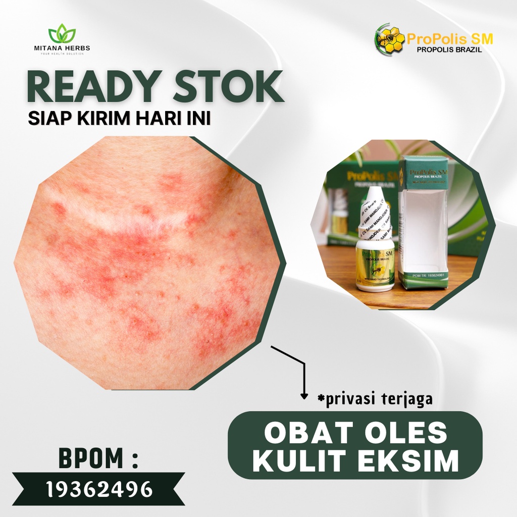 Mitana Herbal / Obat Eksim / Obat Eksim Kering / Obat Gatal Eksim / Obat Eksim Basah / Obat Exim Ker