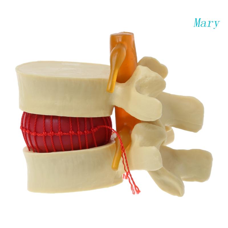 Mary Anatomi Tulang Belakang Lumbar Disc Herniasi Anatomi Alat Mengajar Medis