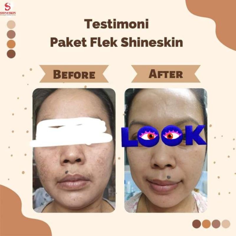 suncare shineskin skincare untuk flek hitam