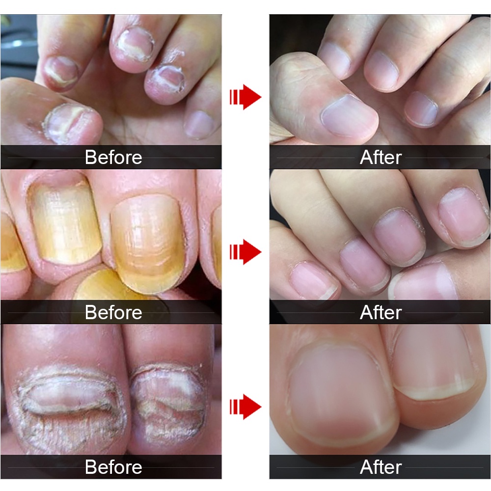 Nail Repair Essence Oil Serum Nail Treatment Perawatan Esensi Serum Jamur Kuku-30ml