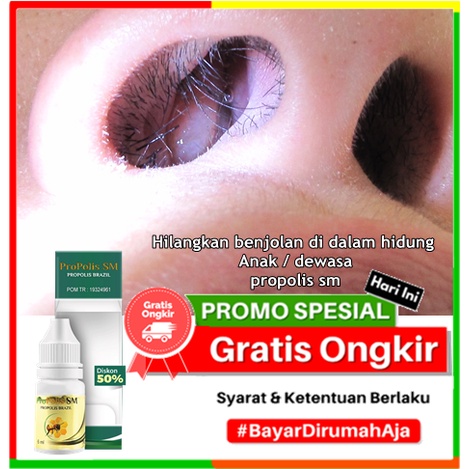 Hilangkan benjolan di dalam hidung Anak / dewasa, propolis sm, operasi polip, penyakit polip, rongga