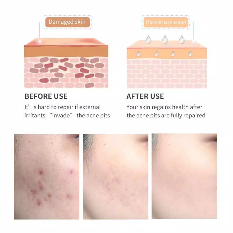 Breylee Acne Scar Removal Gel Penghapusan Jerawat Bekas Luka Pemutih Kulit 30g