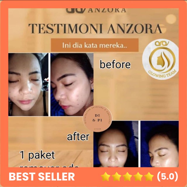 Anzora skincare acne/ANZORA SKINCARE BPOM/cream acne anzora/cream jerawat/ANZORA SKINCARE BANDUNG/PA