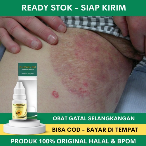 Obat Gatal Selangkangan, Salep Gatal Selangkangan, Obat Selangkangan Hitam, Obat Gatal Selangkangan 