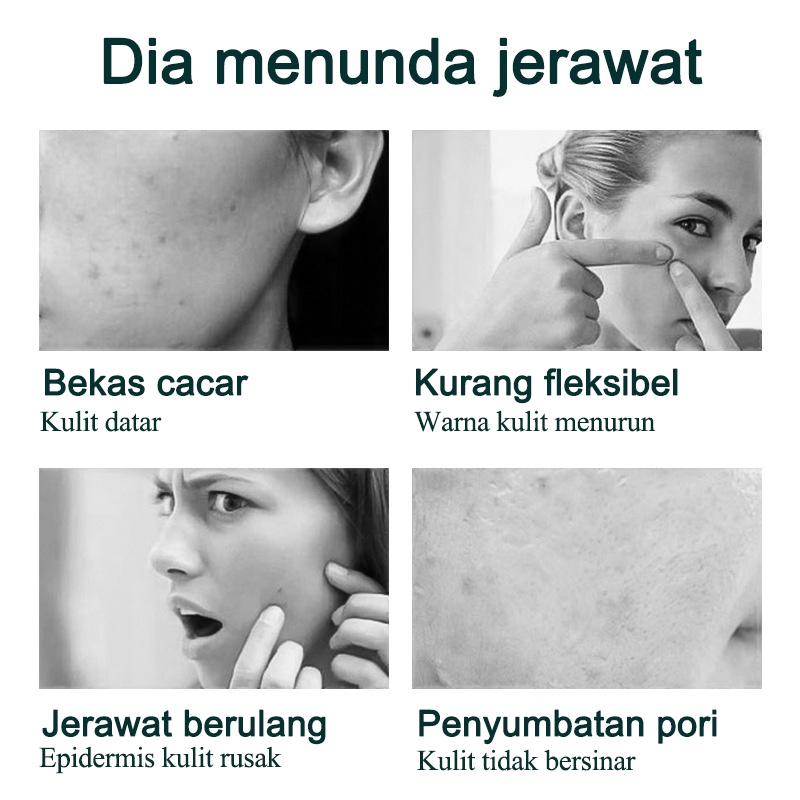 【ORANNLE】[100% Asli] Cream jerawat obat totol jerawat krim jerawat obat jerawat dan bekas jerawat Jerawat Removal of Acne Cream Untuk Pria dan Wanita